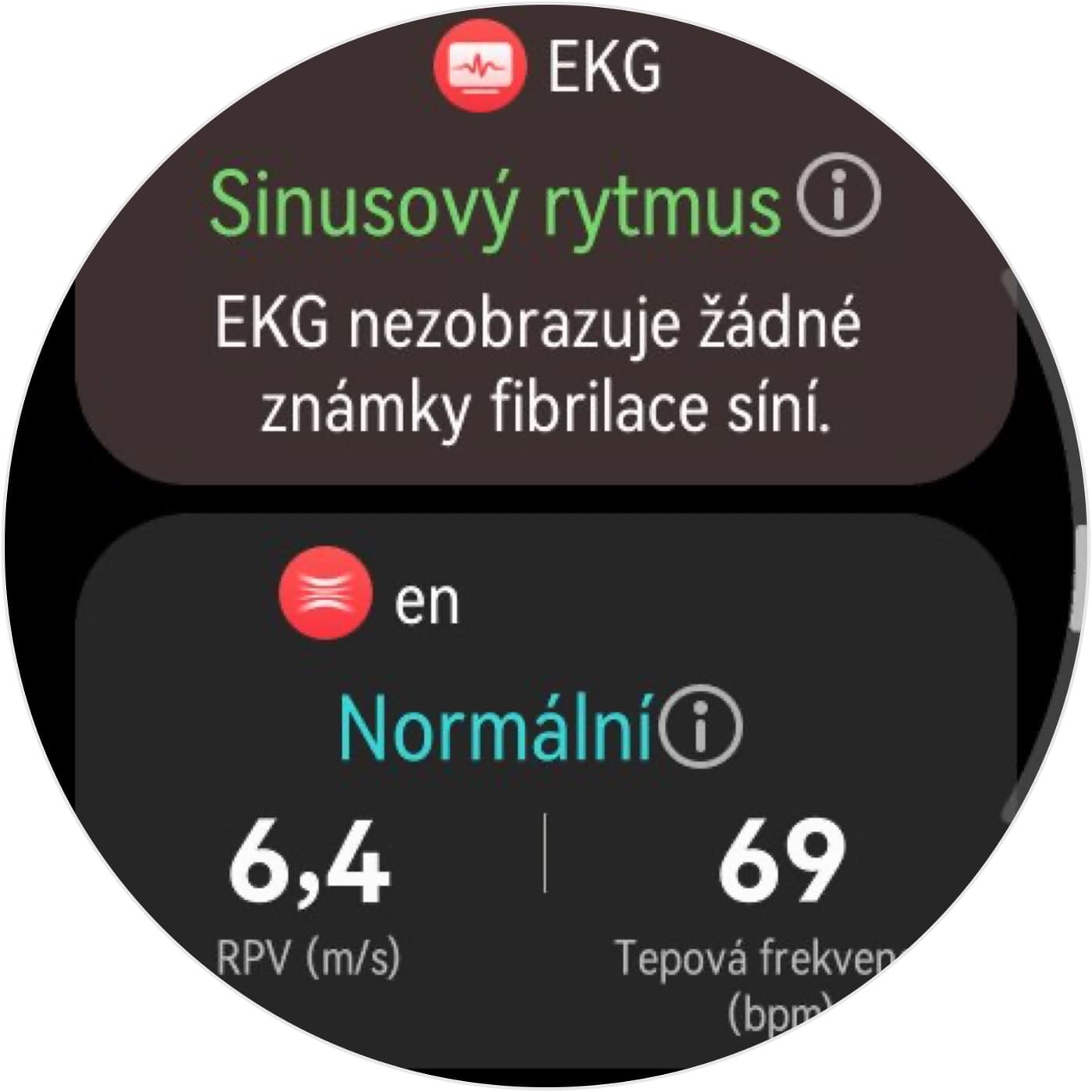 EKG a ztuhlost tepen